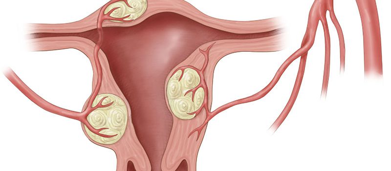 Tratamentul chirurgical modern al fibromului uterin