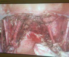 Rolul laparoscopiei in tratamentul neoplasmului colului uterin