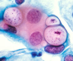 Infectia genito-urinara – chlamydia trachomatis