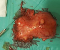 Fibrom uterin voluminos tratat laparoscopic