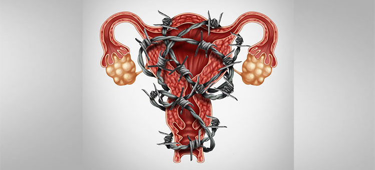 Endometrioza profunda. Fistula recto-vaginala. Video.
